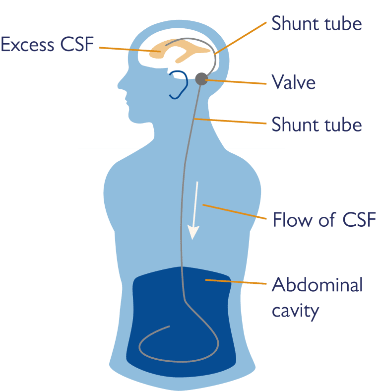 Hydrocephalus and Shunts | Fact Sheet | Health Information | Brain ...